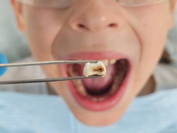 Best Emergency Wisdom Teeth Removal in Wharton, TX